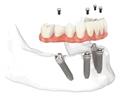 Photo of Dental Implants Professionals