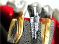 Photo of Dental Implants Professionals