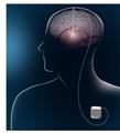 Photo of TDCS Brain Care