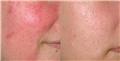 Photo of DermCare - Photo Rejuvenation Platelet Rich Plasma