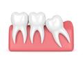 Photo of Wisdom Teeth Professionals